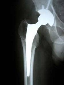 failed hip replacement operation