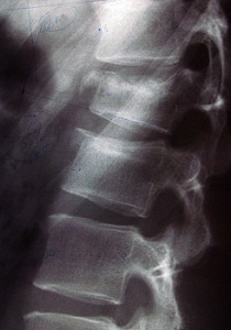Negligent Spine injury compensation claims